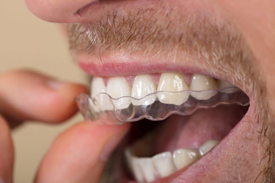 How Do You Clean Your Invisalign Retainers & Tray?