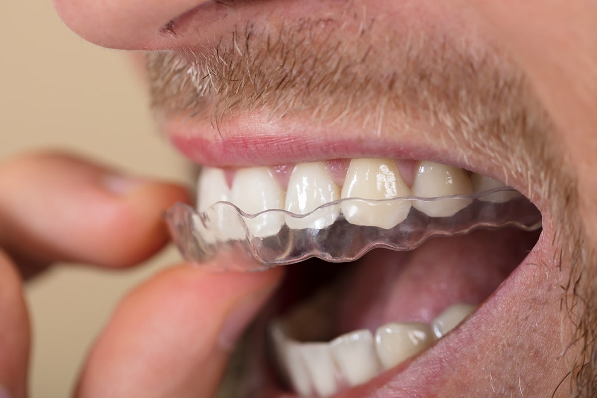 https://www.suffolkpediatricdentistry.com/wp-content/uploads/how-do-you-clean-your-invisalign-retainers-tray-blog.jpg