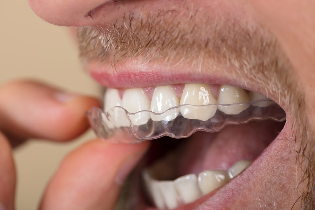 Invisalign  Route 9 Dental