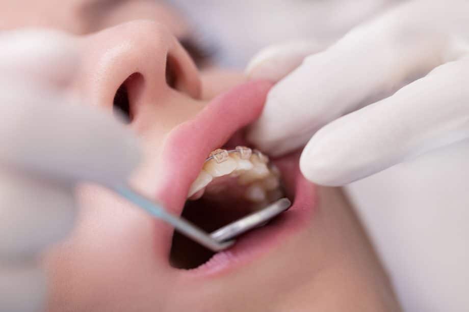 dentist examines the teeth of a child with braces