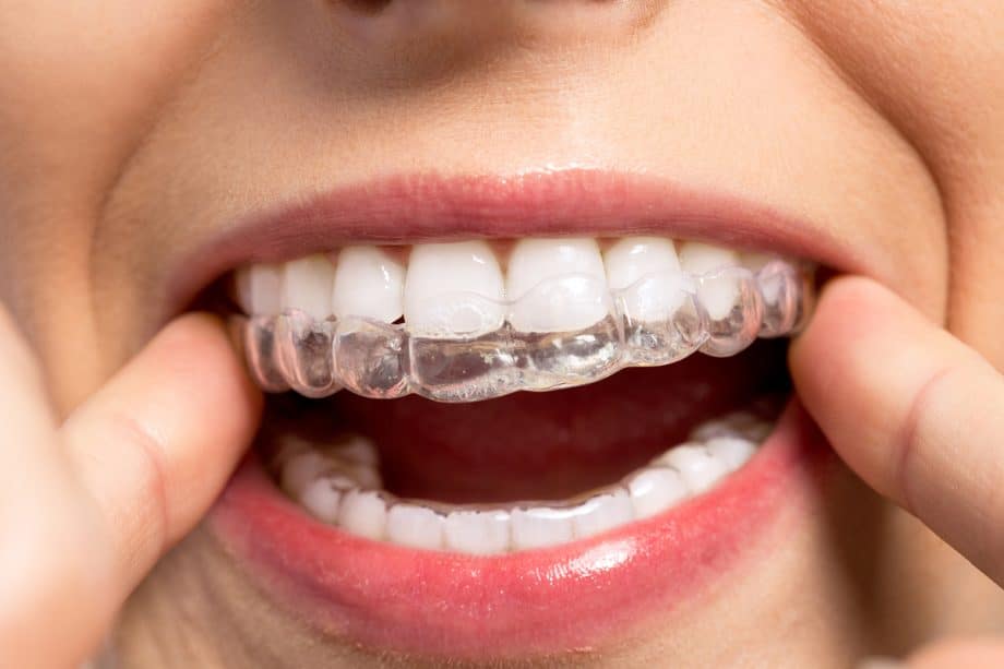 How Does Invisalign Work?