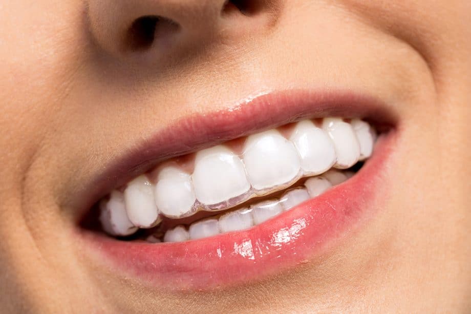 mouth with Invisalign aligner smiles