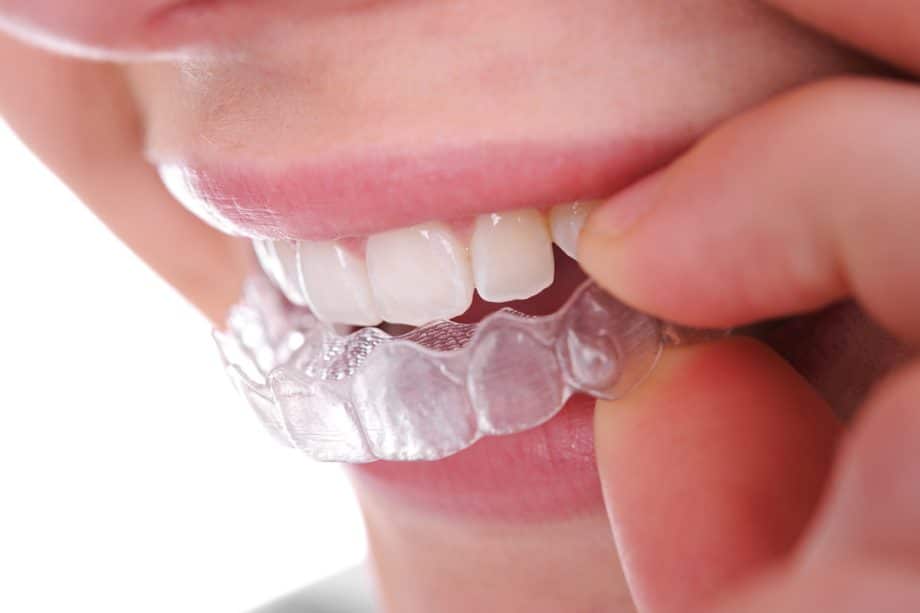 How Long Does Invisalign Take to Straighten Your Teeth?
