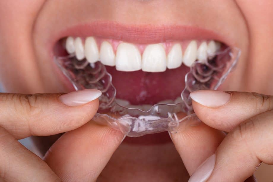 a person inserts an Invisalign aligner into mouth