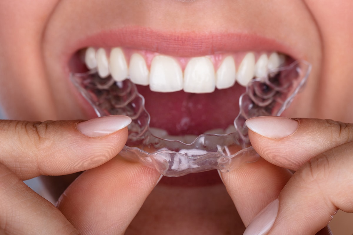 How Much Does Invisalign Cost in Suffolk County, NY?