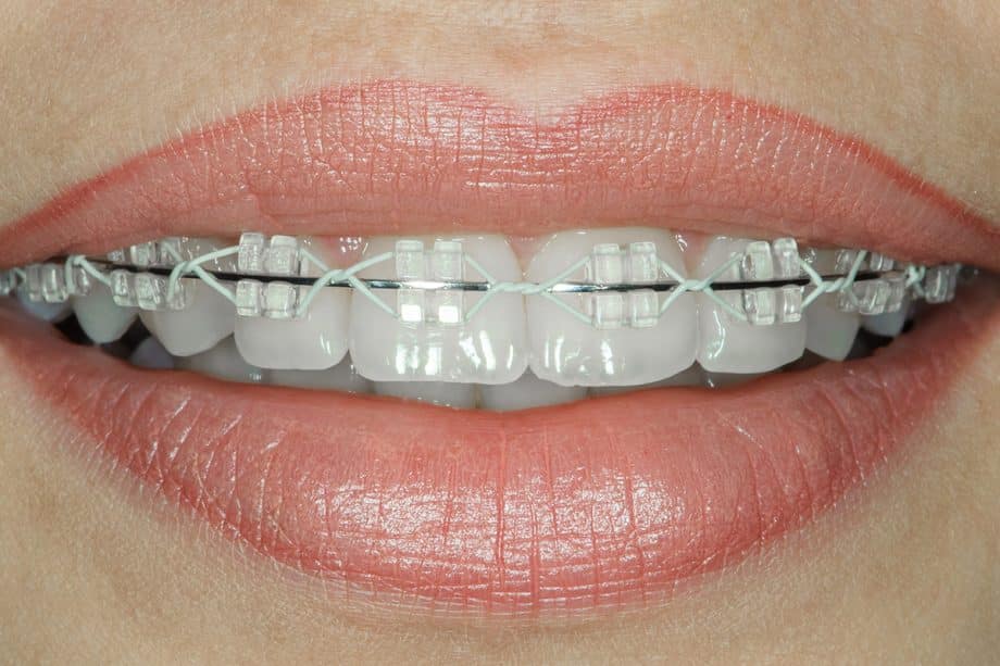 Key Differences Between Interceptive and Traditional Orthodontics