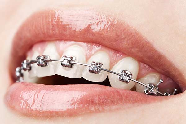 Traditional Metal Braces