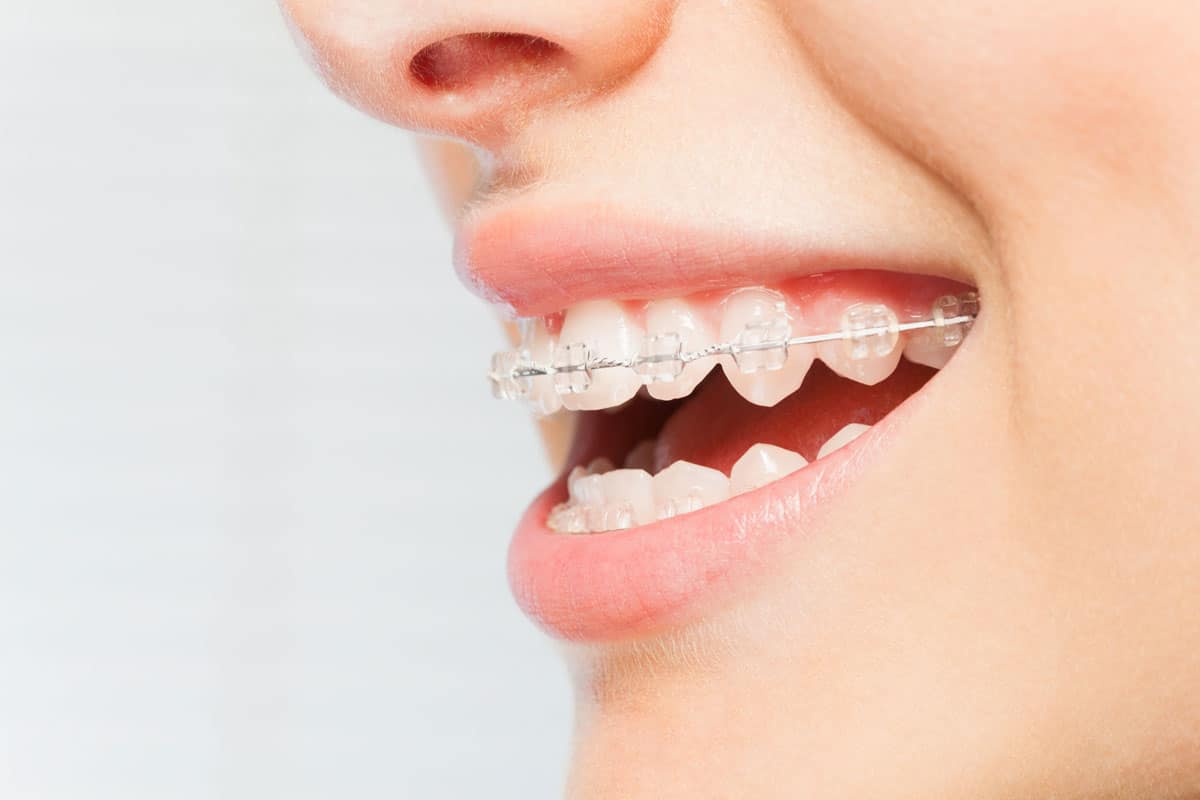 How Do Braces Work? - Ask an Orthodontist.com